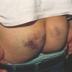 Mais de 200 camponeses ficaram com graves sequelas físicas e psicológicas, muitos feridos a bala continuam com elas encravadas no corpo até hoje. Cinquenta e cinco camponeses foram gravemente feridos.